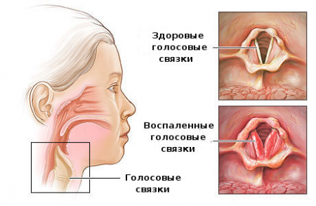 ларингит