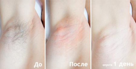 Эпиляция подмышек: до и после