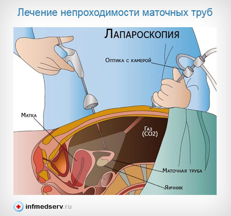 Лапароскопическая операция