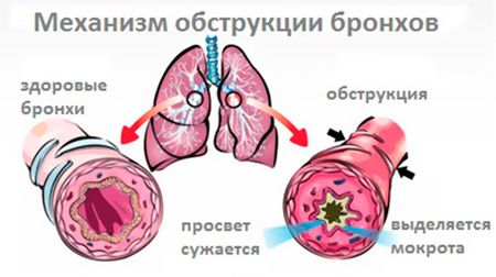 обструктивный бронхит