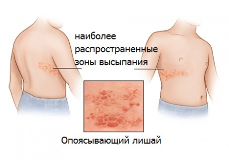 опоясывающий лишай опоясывающий лишай