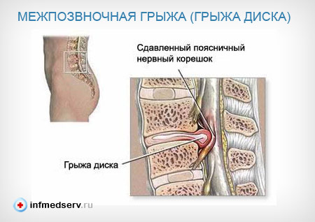 Межпозвоночная грыжа поясничного отдела Межпозвоночная грыжа поясничного отдела