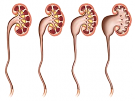 степени гидронефроза