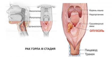 опухоль гортани опухоль гортани