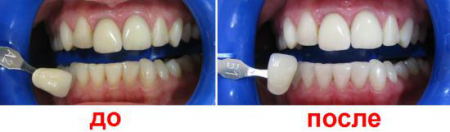 Результаты отбеливания Результаты отбеливания