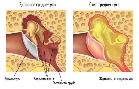 Отит среднего уха
