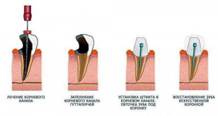 Этапы лечения и установки коронки Этапы лечения и установки коронки