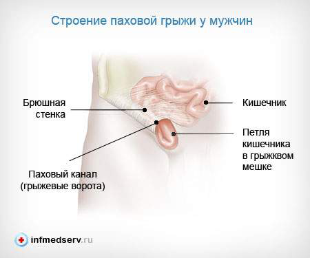Строение паховой грыжи Строение паховой грыжи