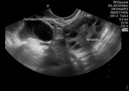 Параовариальная киста яичника фото