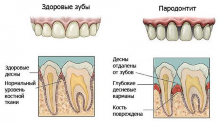 Здоровый и больной зуб Здоровый и больной зуб