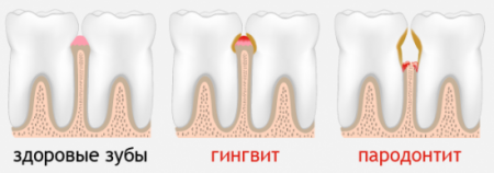 Стадии развития заболевания десен Стадии развития заболевания десен