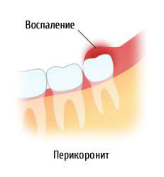 Перикоронит