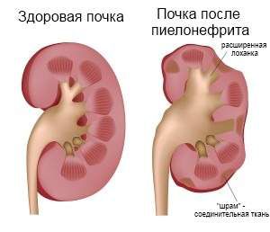 Пиелонефрит Пиелонефрит