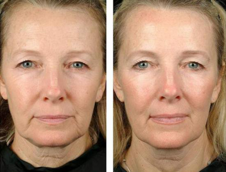 Фото до и после Фото до и после