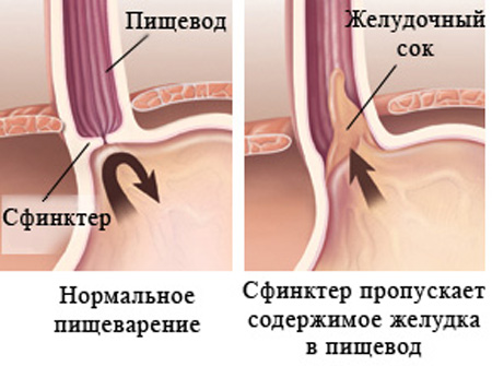 причины изжоги
