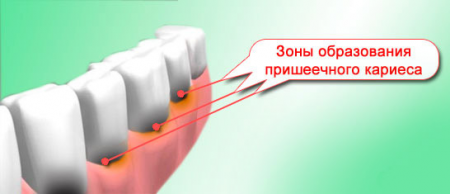Предесневой кариес