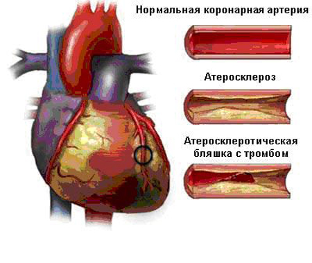 стенокардия