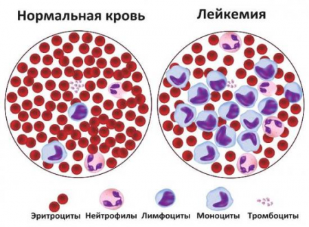 лейкоз лейкоз
