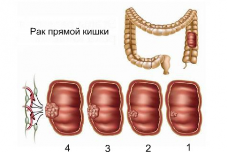 стадии рака прямой кишки
