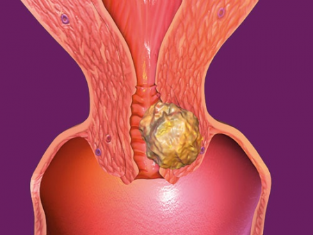 папиллома папиллома