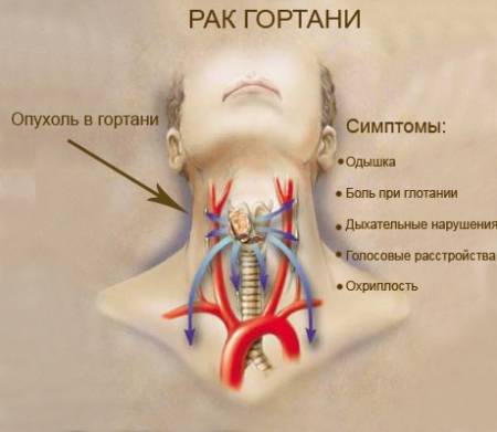 симптомы рака горла