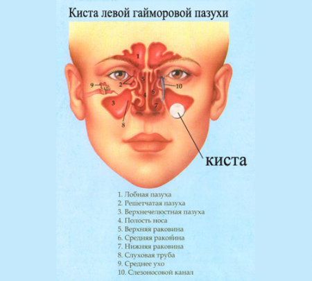 Киста гайморовой пазухи