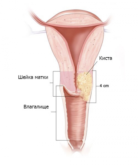 Киста шейки матки Киста шейки матки