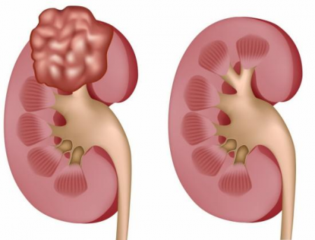 рак почки рак почки