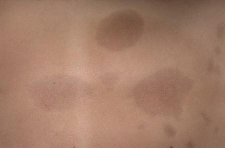 Очаговая склеродермия Очаговая склеродермия