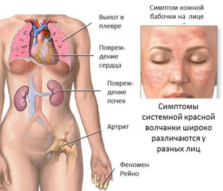 Системная красная волчанка: симптомы