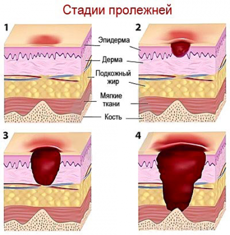 стадии пролежней