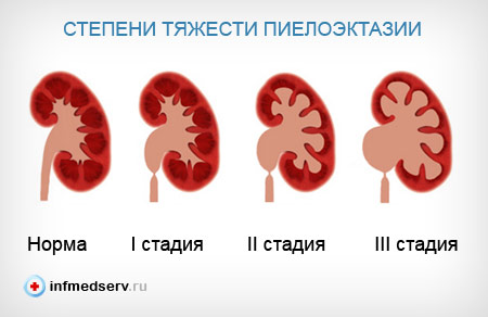 Степени тяжести пиелоэктазии Степени тяжести пиелоэктазии