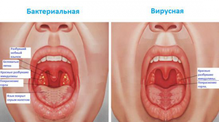 виды ангины