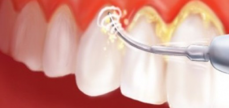 Ультразвуковое удаление зубных отложений Ультразвуковое удаление зубных отложений