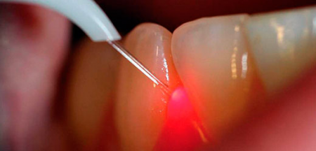 Чистка зубов лазером Чистка зубов лазером