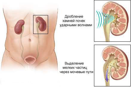 Ультразвуковое дробление камней