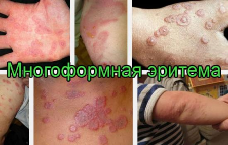 Многоформная экссудативная эритема