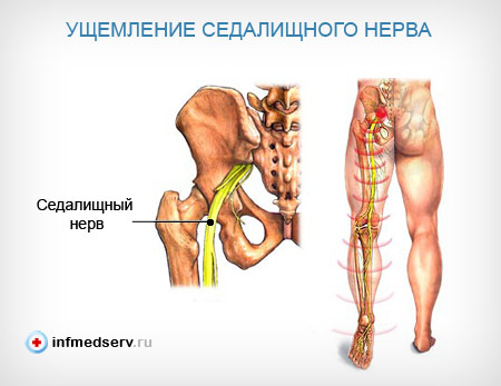 Ущемление седалищного нерва