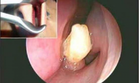 Зуб в носу Зуб в носу