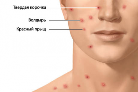 ветряная оспа сыпь
