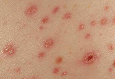 ветряная оспа сыпь