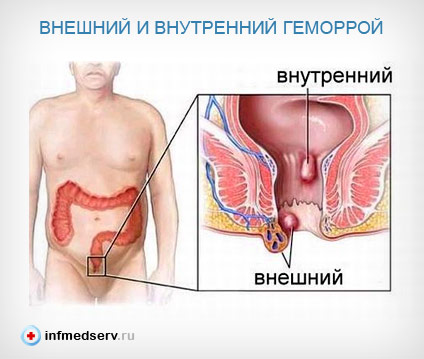 Внешний и внутренний геморрой
