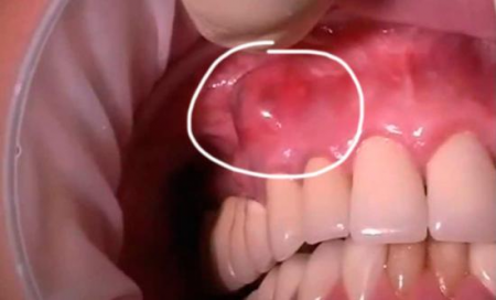 Воспаление на десне Воспаление на десне