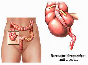 Воспаление аппендикса Воспаление аппендикса
