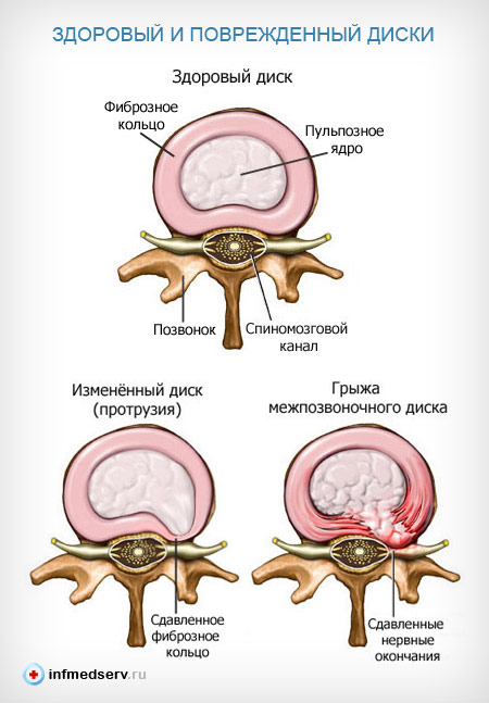 Здоровый и поврежденный межпозвоночный диск Здоровый и поврежденный межпозвоночный диск