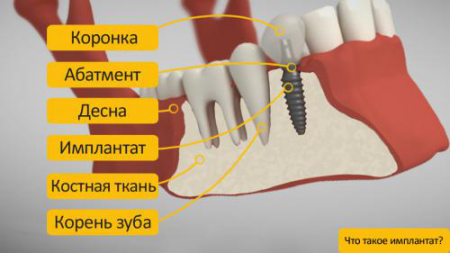 Исскуственный зуб