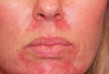 Аллергия на лице у взрослых фото 1 Аллергия на лице у взрослых фото 1