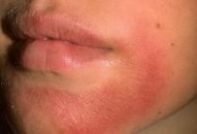 Аллергия на лице у взрослых фото 2 Аллергия на лице у взрослых фото 2