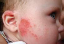 Аллергия на лице у детей фото 1 Аллергия на лице у детей фото 1