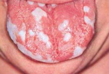 кандидозный стоматит 1 кандидозный стоматит 1